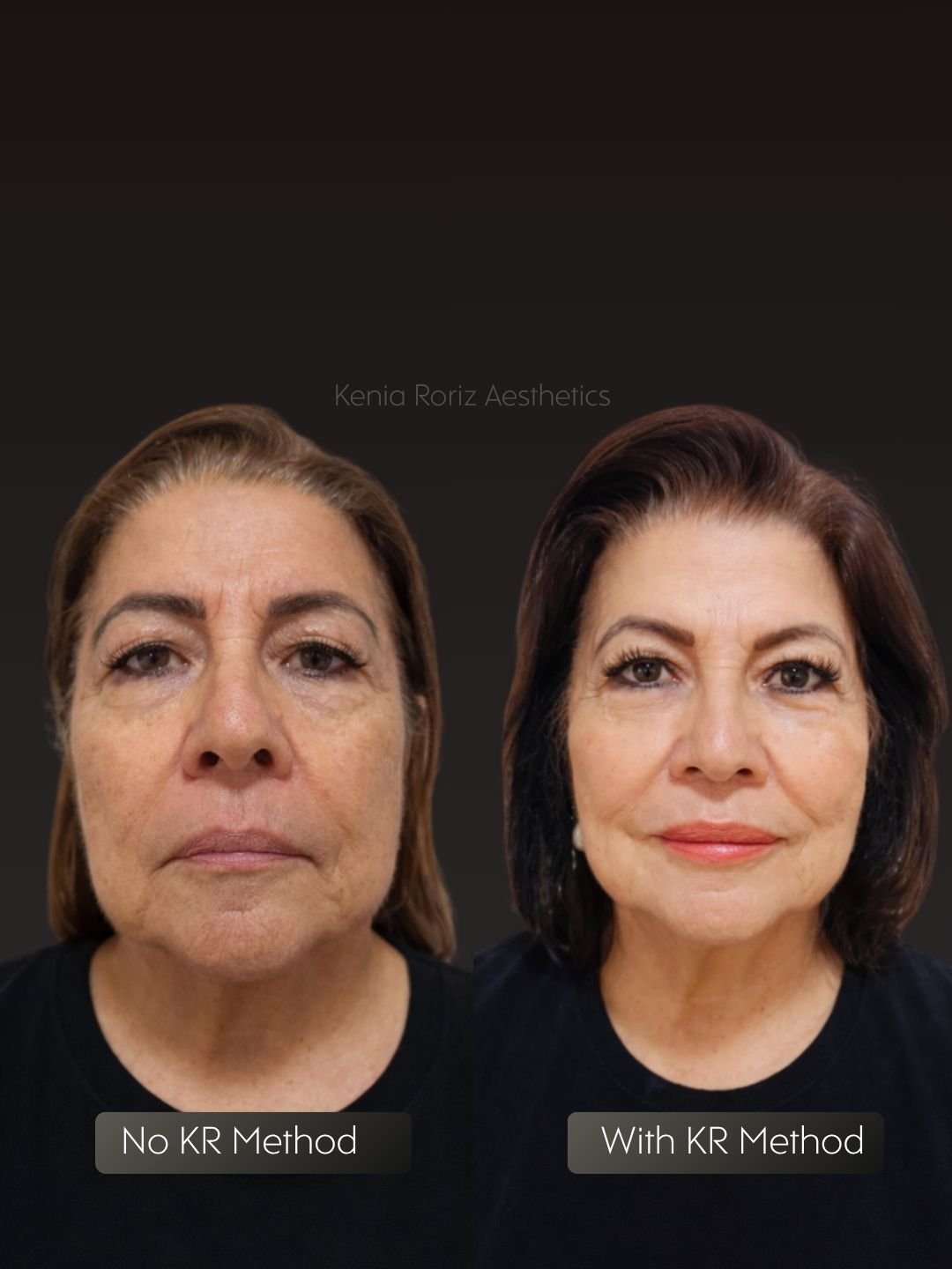 KR Method before and after