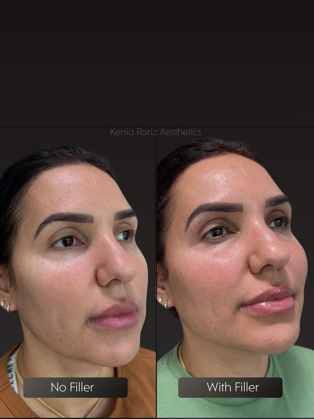Face Filler before and after