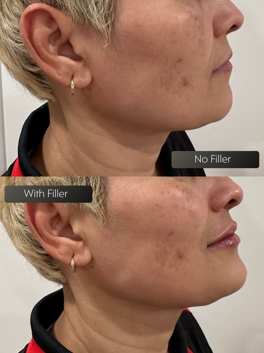 Face Filler before and after