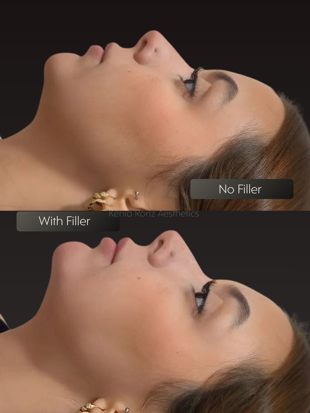 Face Filler before and after