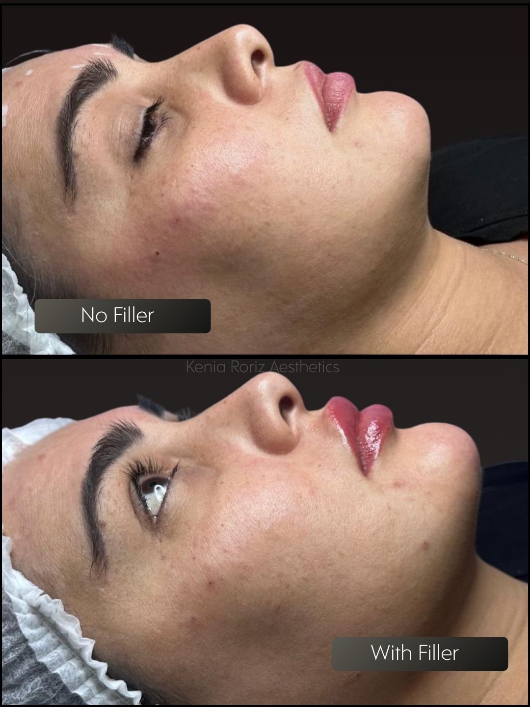 Face Filler before and after