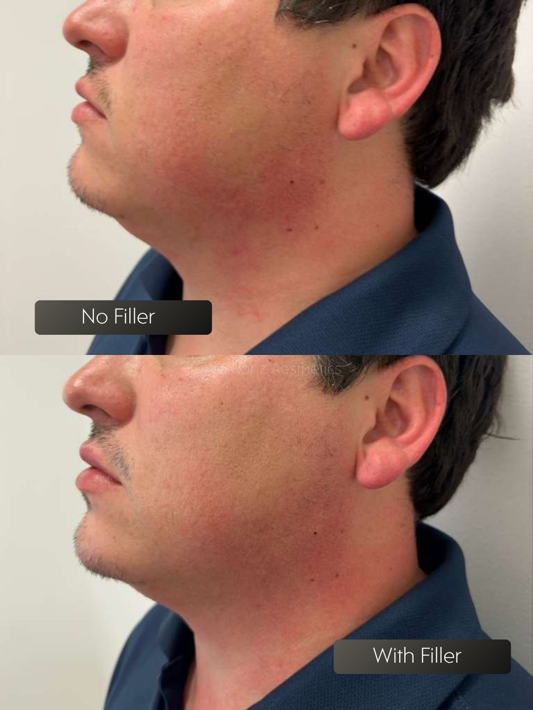 Face Filler before and after