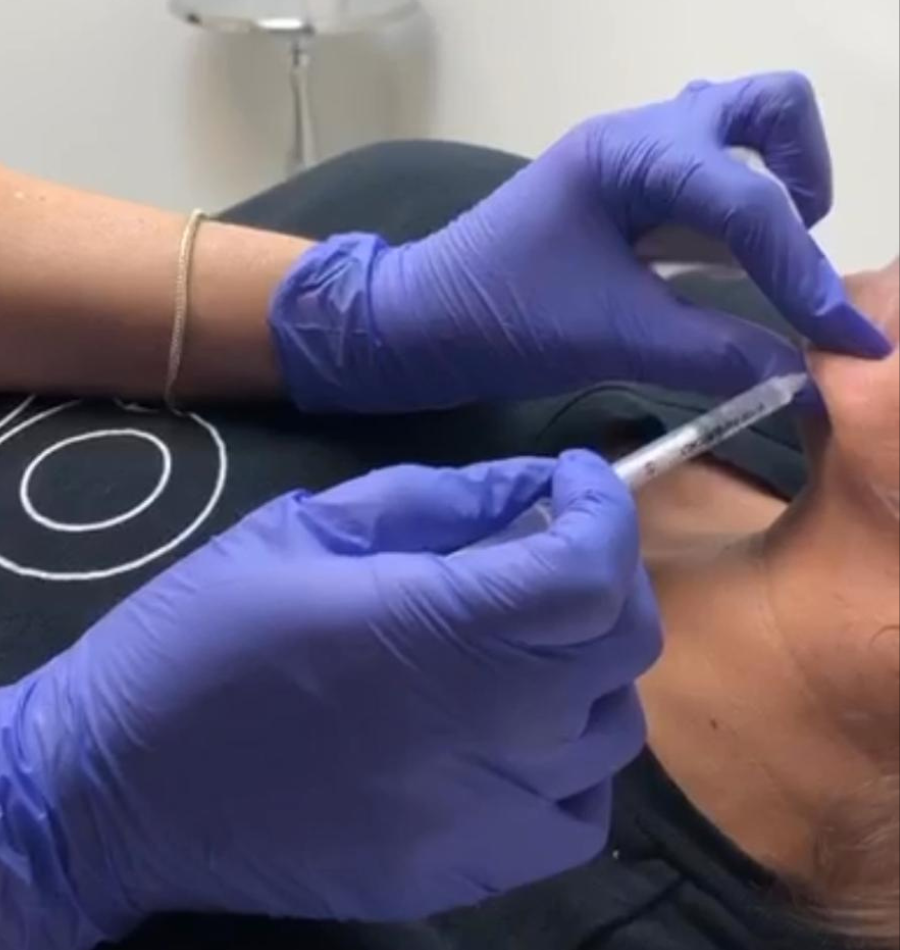 Facial filler
