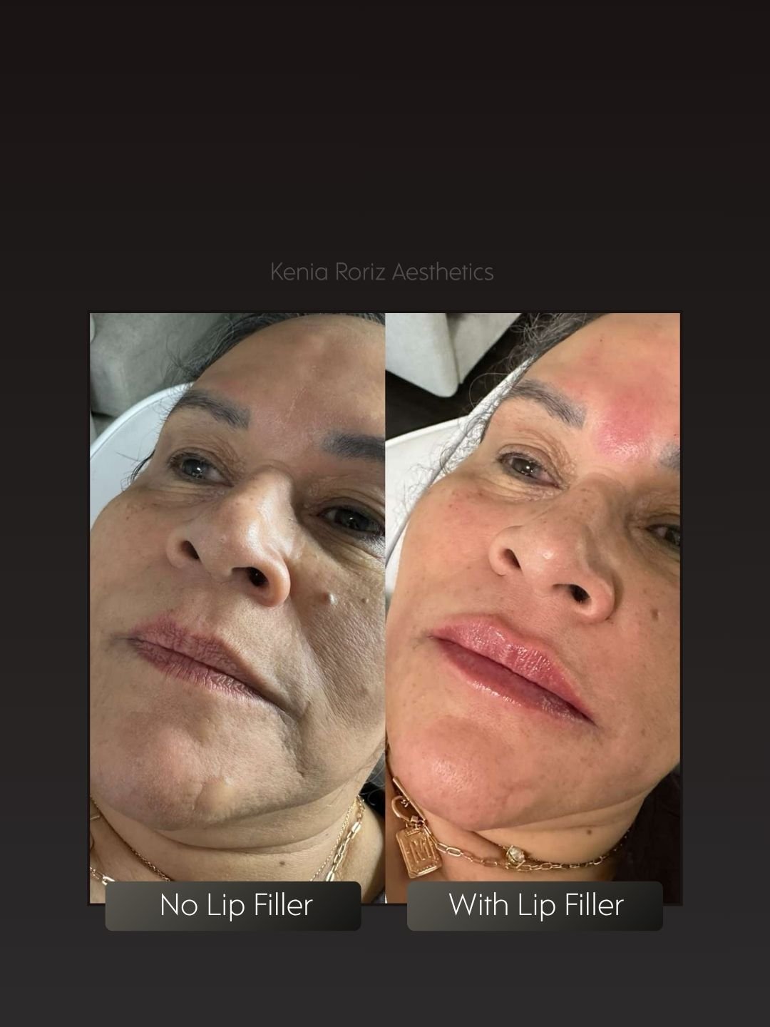 Lip Filler before and after