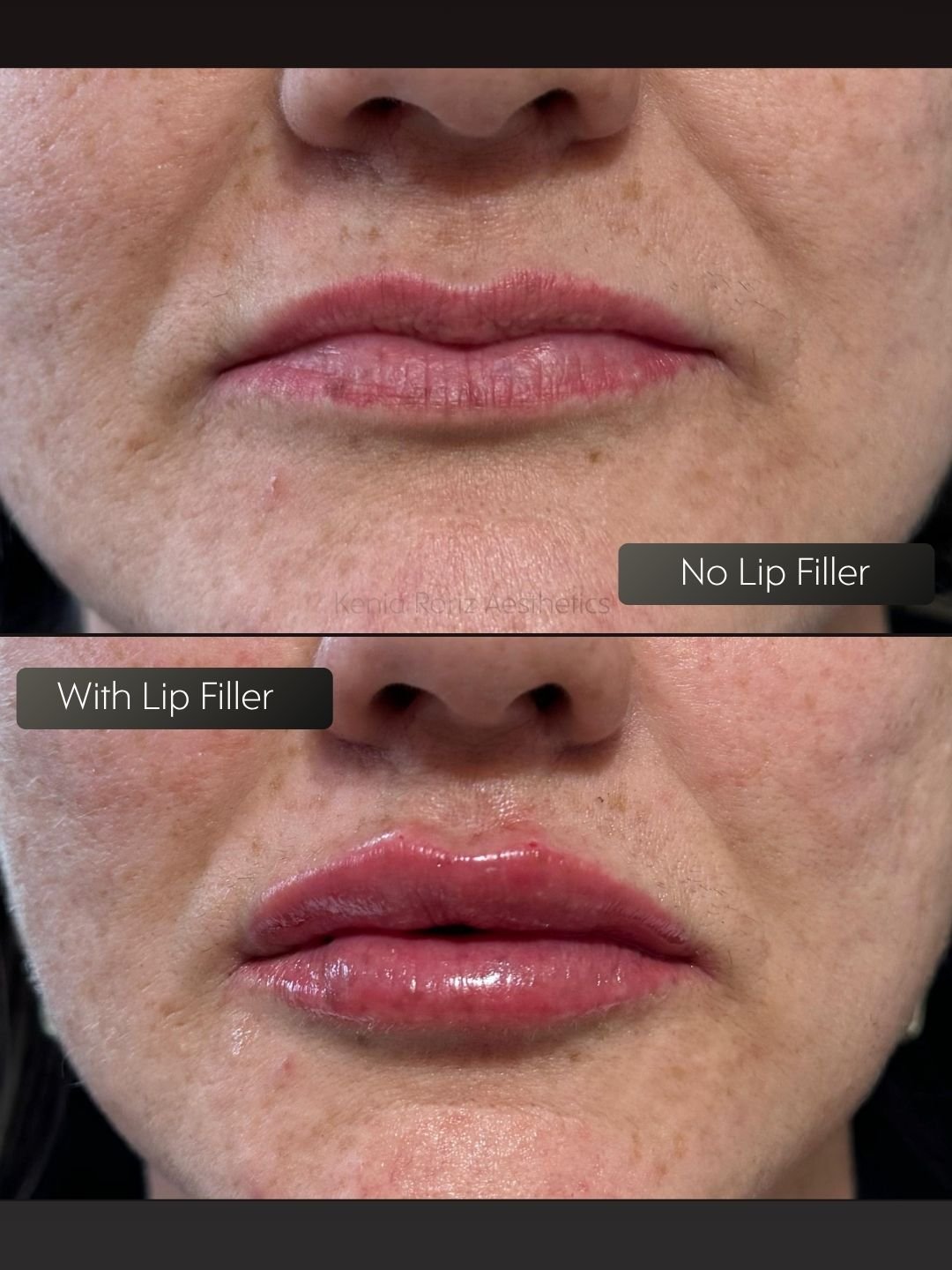 Lip Filler before and after