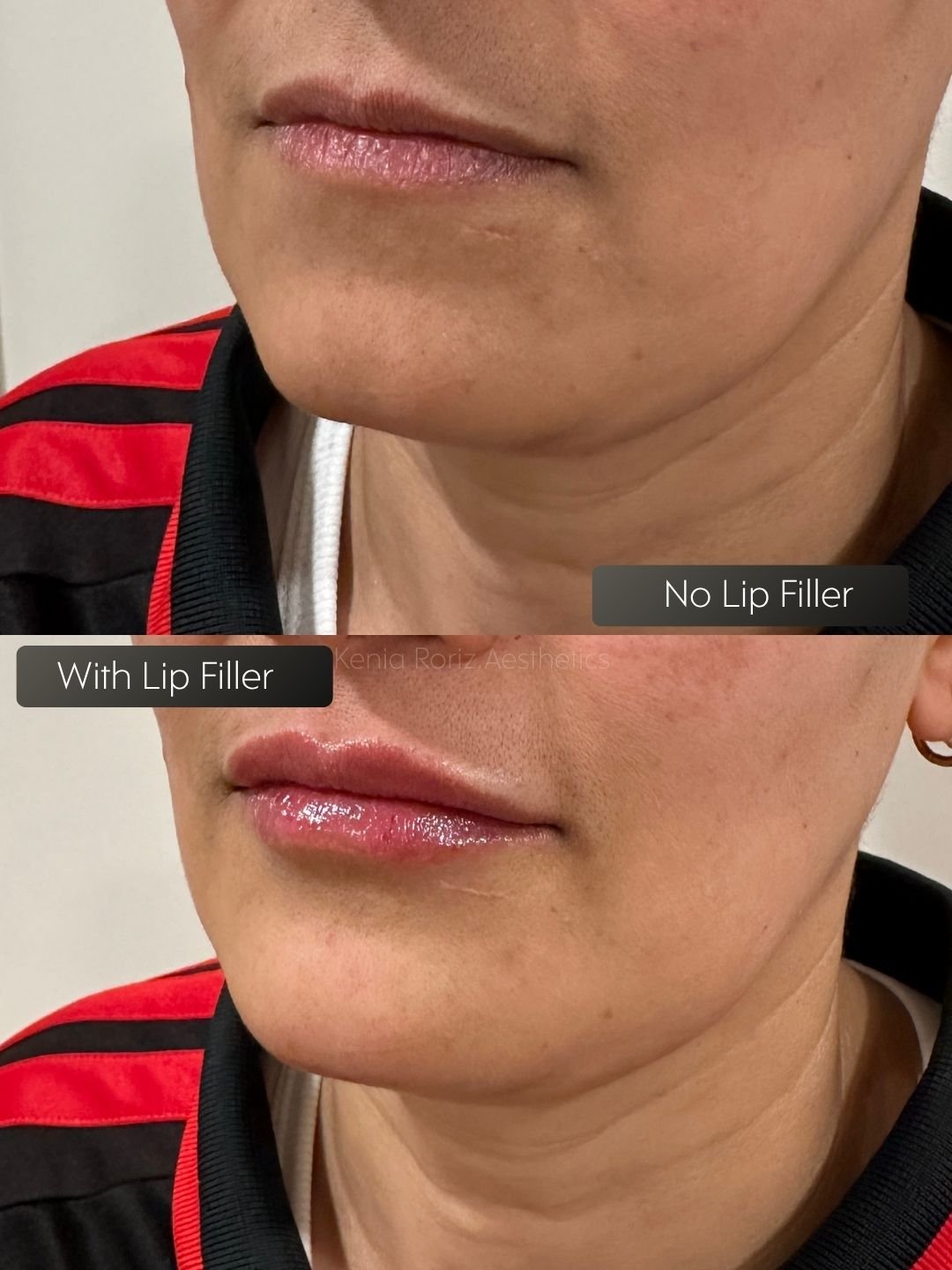 Lip Filler before and after