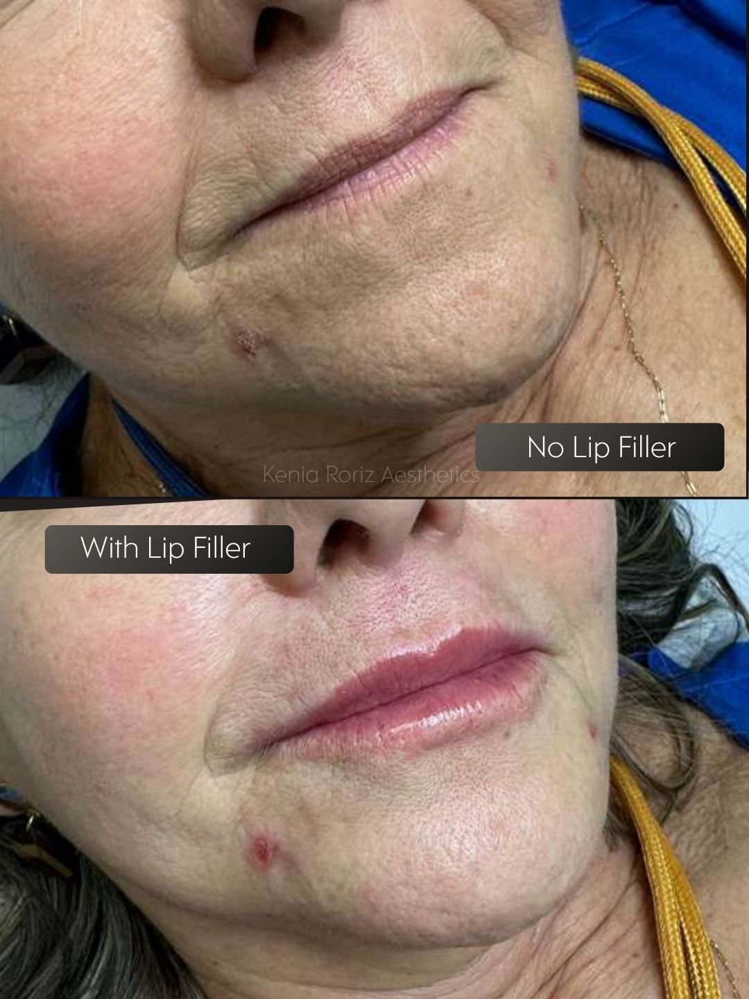 Lip Filler before and after