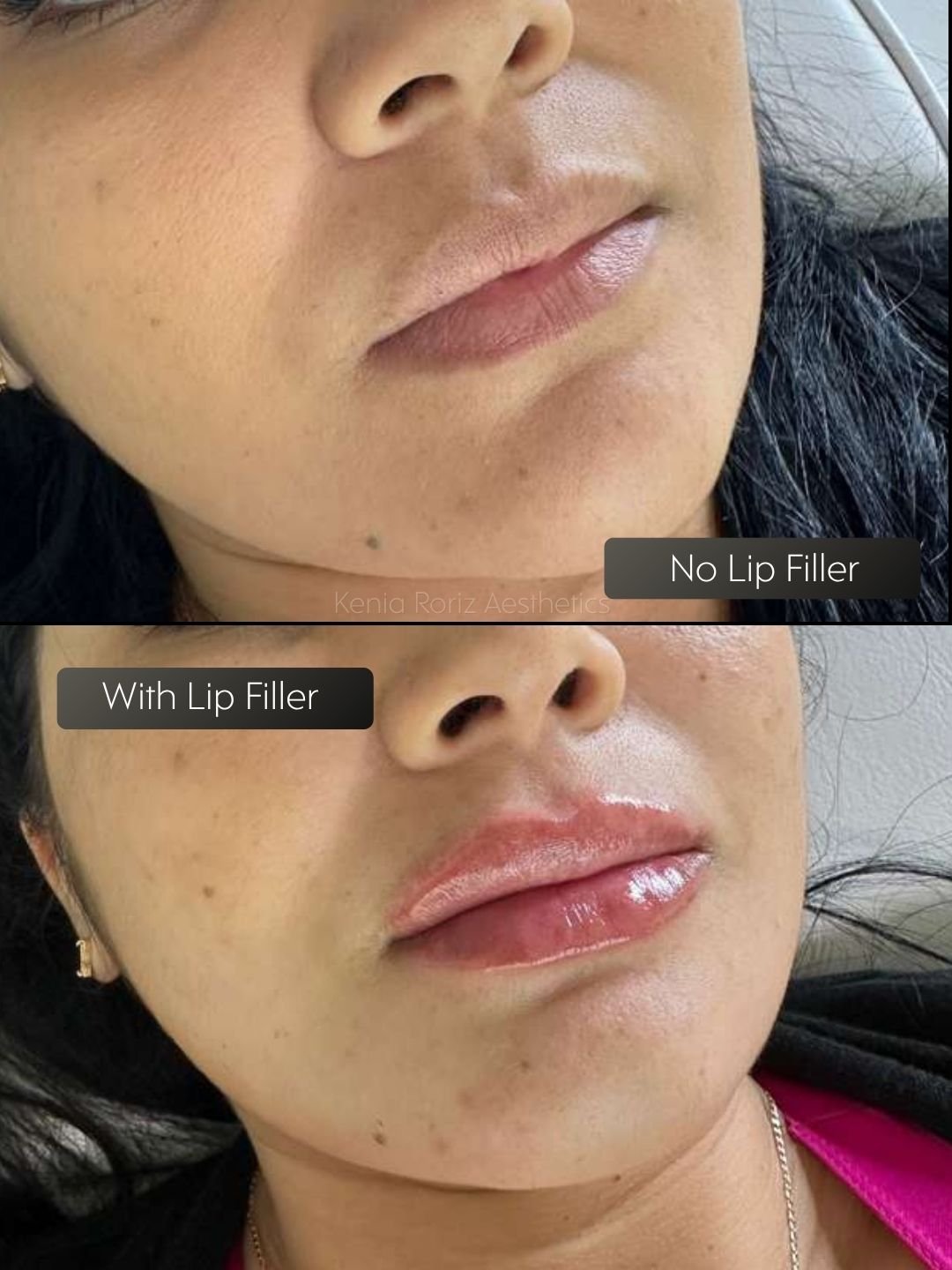 Lip Filler before and after