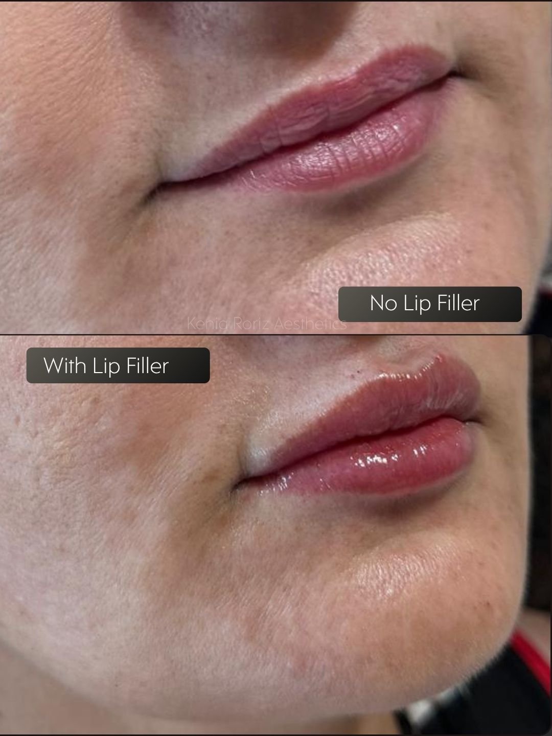 Lip Filler before and after