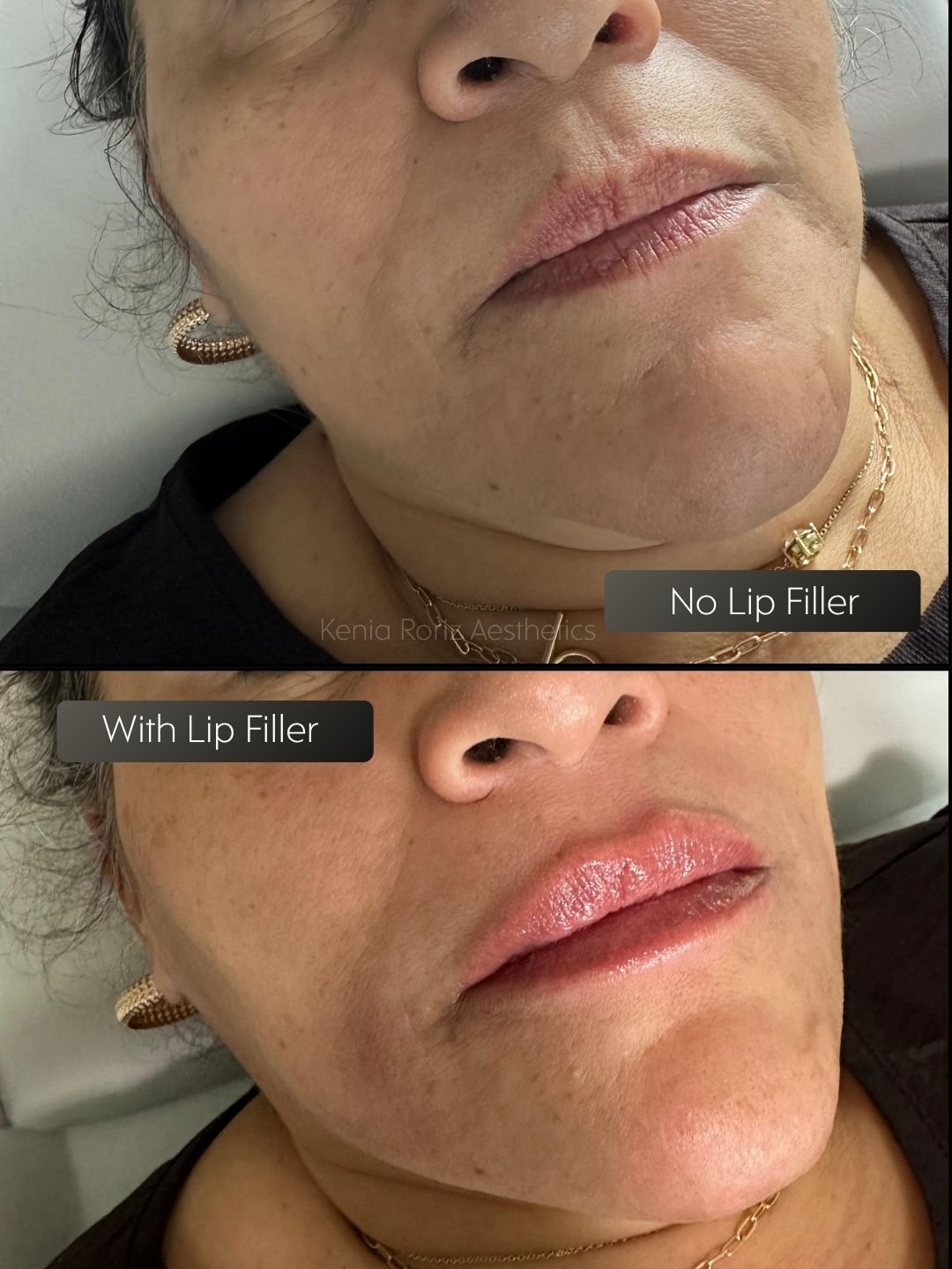 Lip Filler before and after
