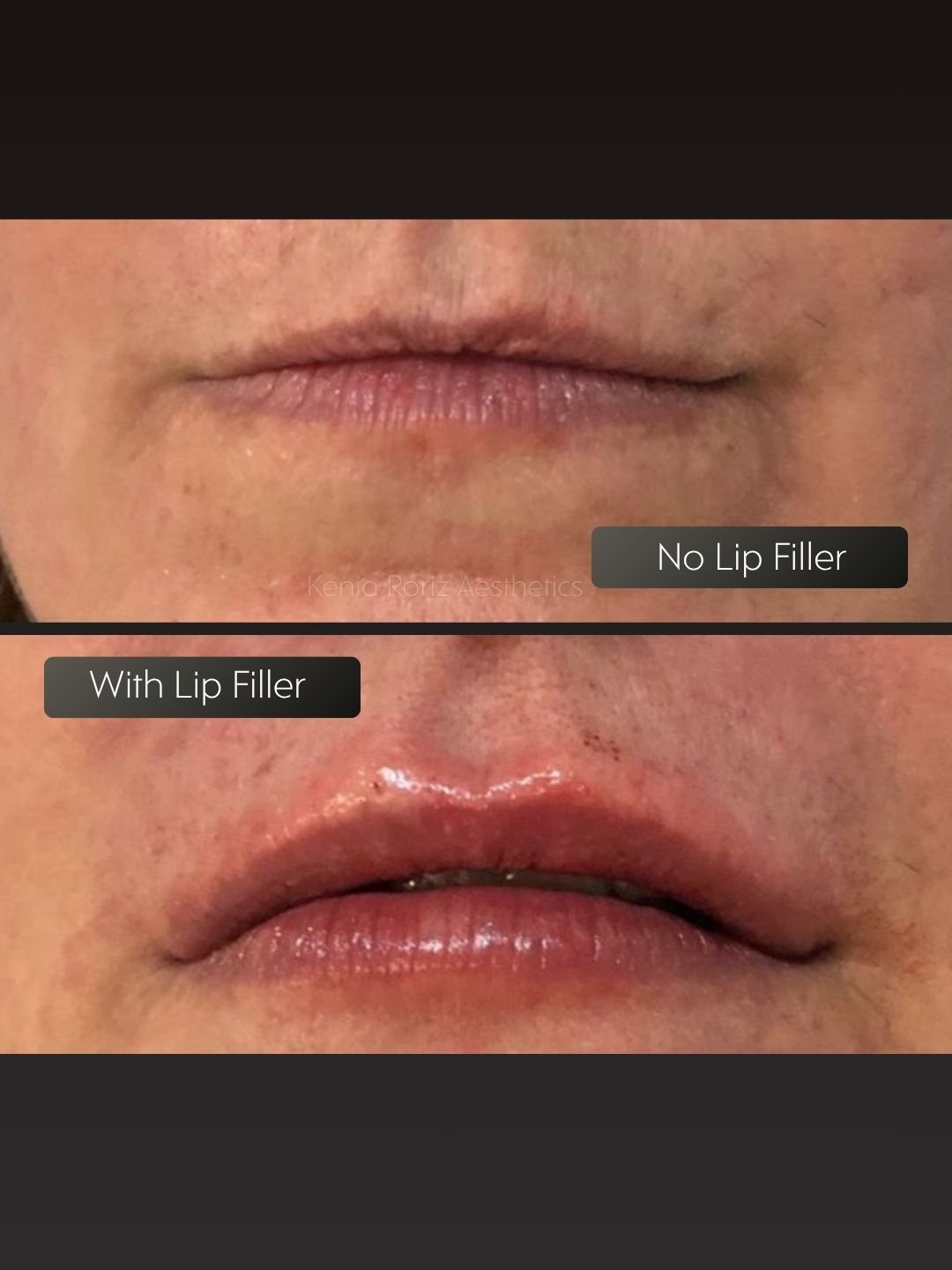 Lip Filler before and after