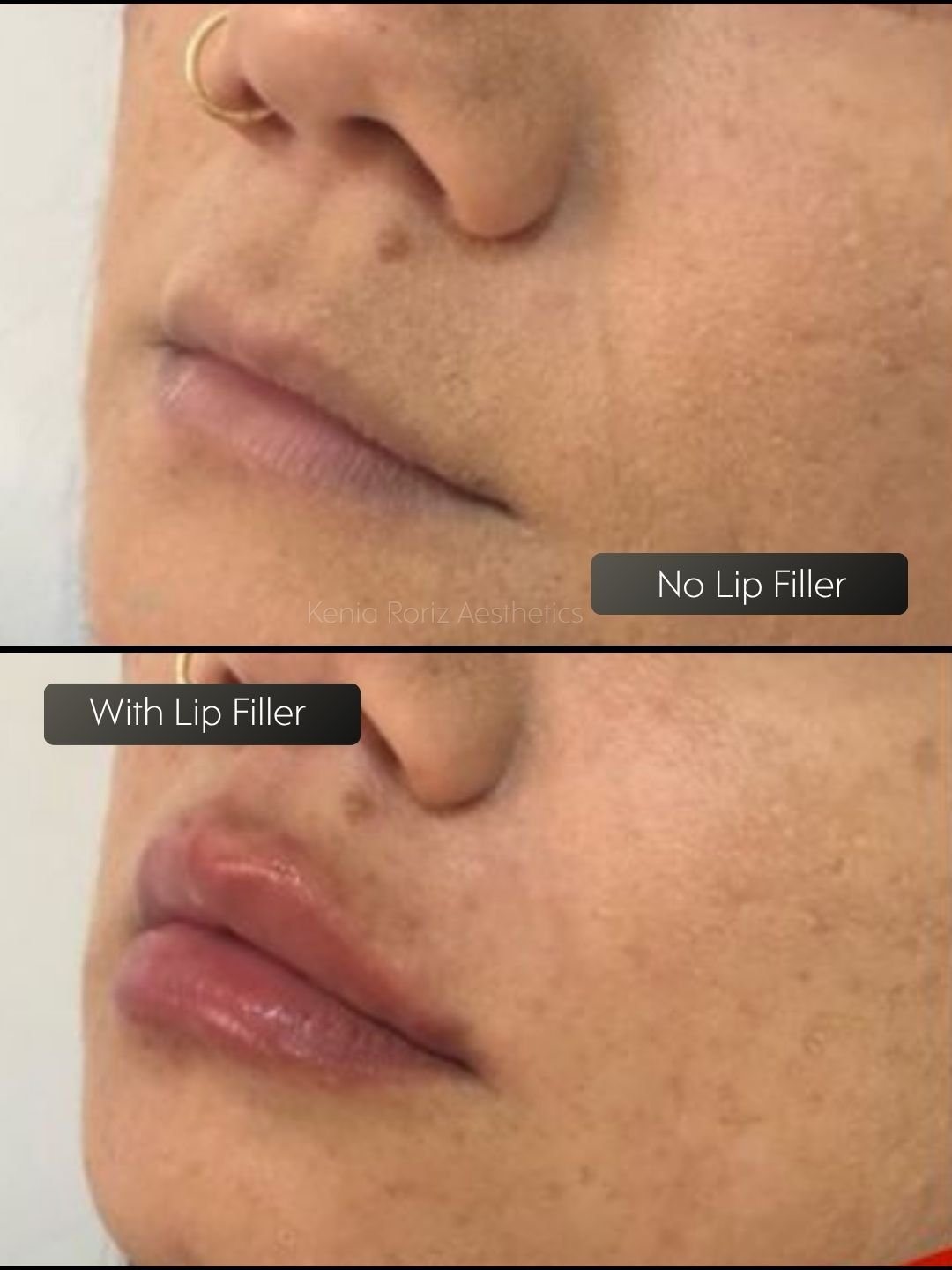 Lip Filler before and after