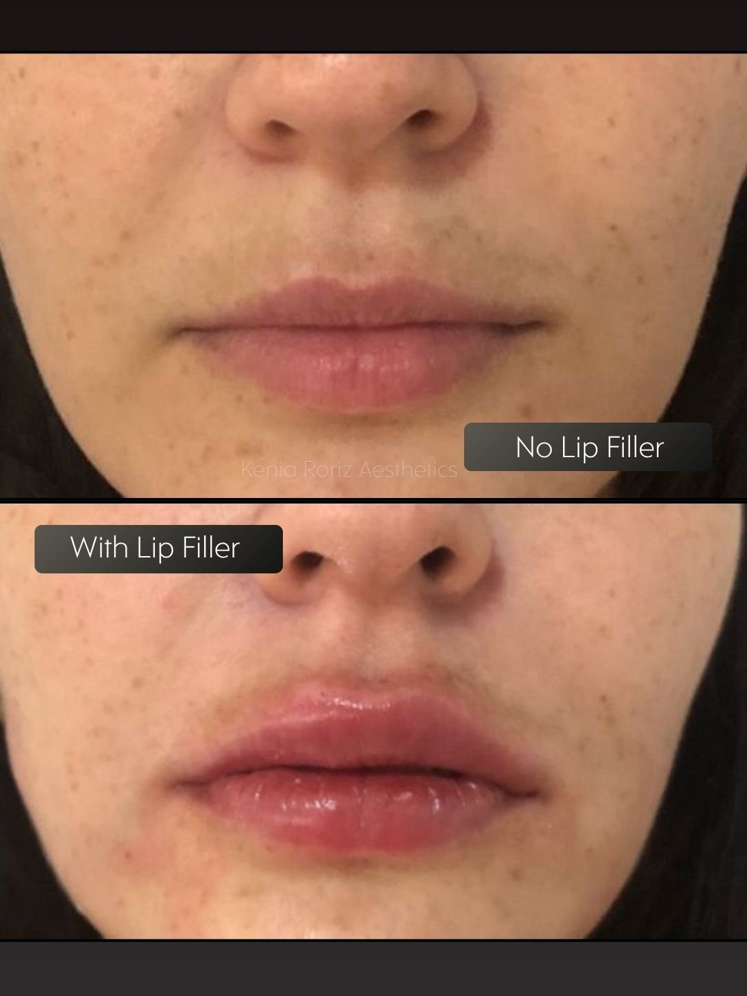 Lip Filler before and after
