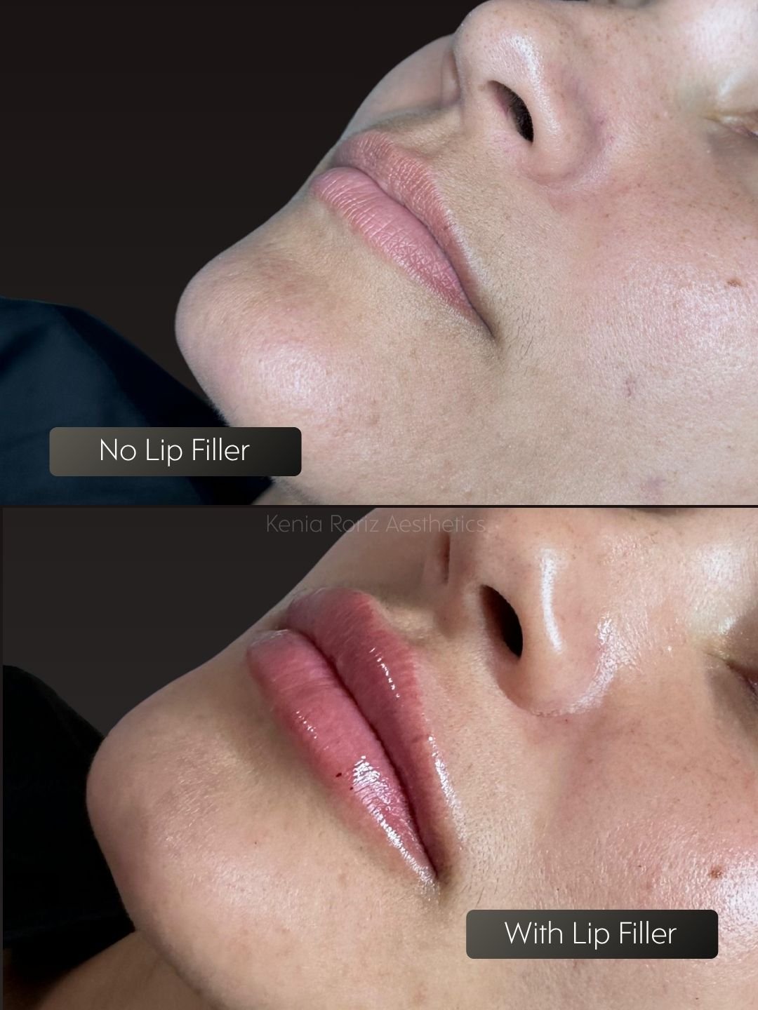 Lip Filler before and after