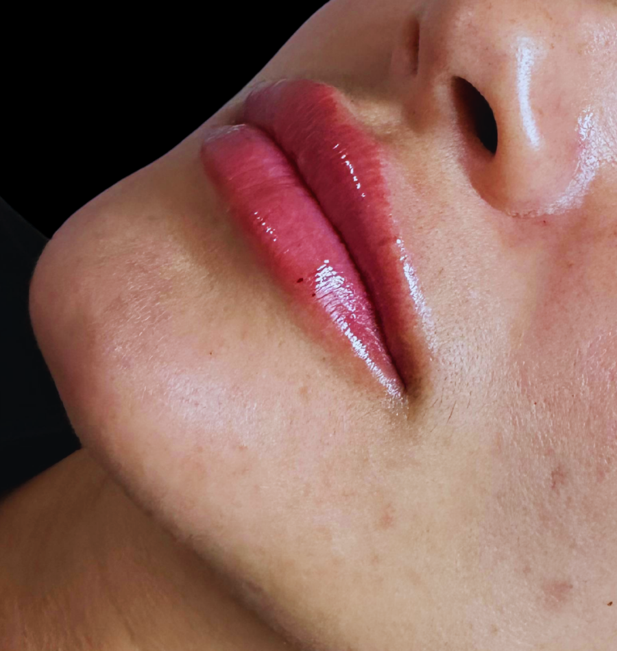 Lip filler