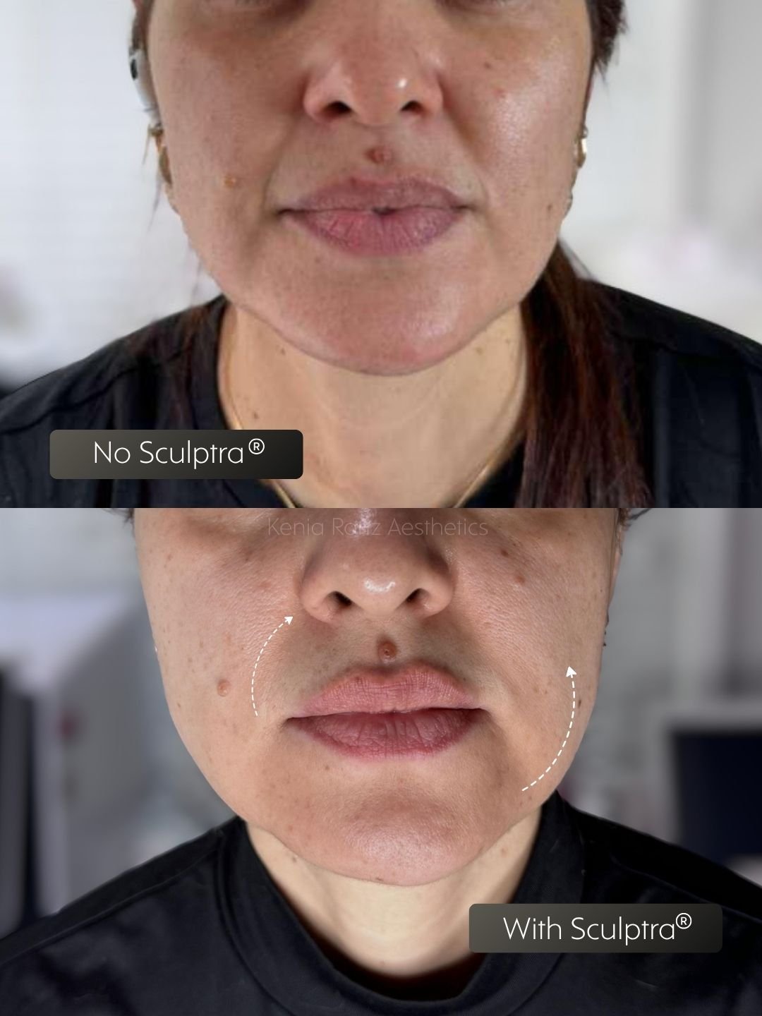 Sculptra before and after